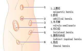 女孩子也会得疝气