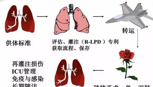 北京西京中医医院李勇专家,讲解肺移植