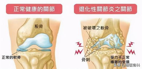 跑完步出现 膝盖疼痛 ,怎么回事 如何破解