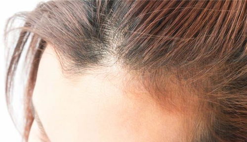 秋季女性脱发的原因(秋季是不是脱发比较严重)