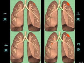 早期肺癌,手术治疗提高生存率 