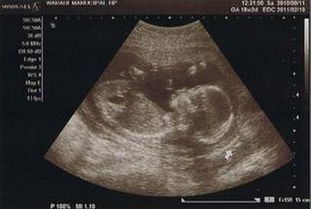 孕18周(怀孕18周胎儿发育情况及注意事项)