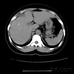 肝CT平扫 强化,帮忙看下