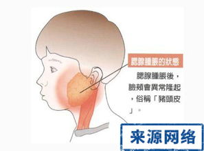 腮腺炎会反复发作吗(腮腺炎怎么治疗)