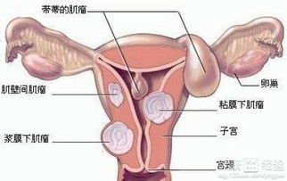 腹腔镜全子宫及附件切除术后怎么保养