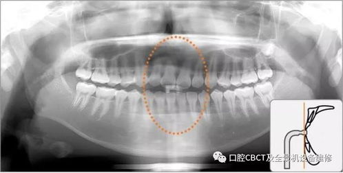 口腔全景X光机建议操作流程及注意事项