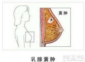 乳腺囊肿的治疗方法