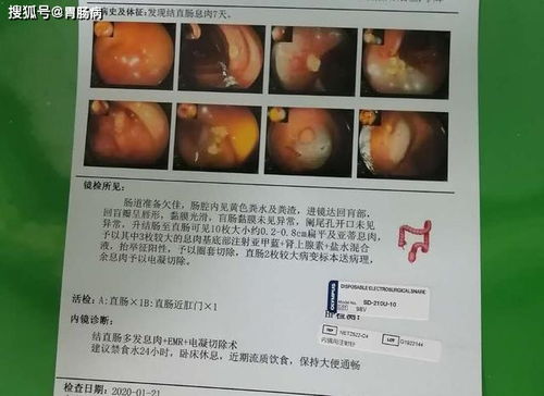 做完腸胃鏡息肉後三天飲食表