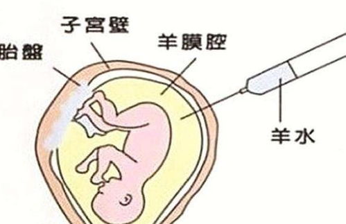 羊水穿刺后破水保胎的几率有多大