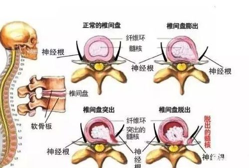 腰椎间盘突出,这样治疗