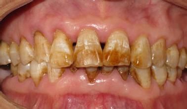 麦芽口腔知识分享 导致氟斑牙的原因有哪些