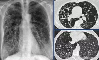 慢阻肺COPD无法治愈,彻底根治不可能,但不是不治之症 