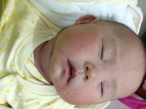 奶癣和湿疹的区别图片 宝宝长奶癣是因为喝奶引起的吗？应该怎么办？ 