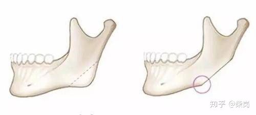 下颌角骨骼大用什么方法去除(下颌骨大什么方法可以变小)