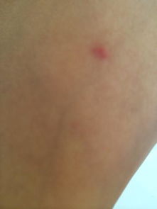 腿上起了好多这样的小红疹,是被虫子咬的还是皮肤病 