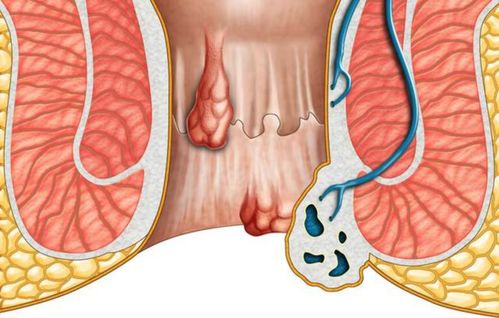 痔疮严重必须手术吗(痔疮严重的一定要手术吗)