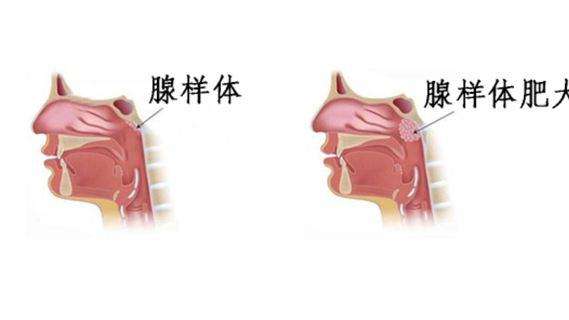 百逸信中医 腺样体肥大是不是只需要手术一刀切就行了呢