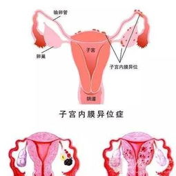 子宫内膜异位症的后果(子宫内膜异位症的危害有哪些)