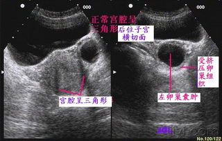 正常子宫和卵巢图片集