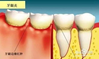 牙龈肿痛是什么原因造成的 