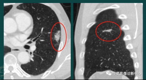 影像科的真相 粘液腺癌细胞会伪装,医生教你用CT扫描抓 贼