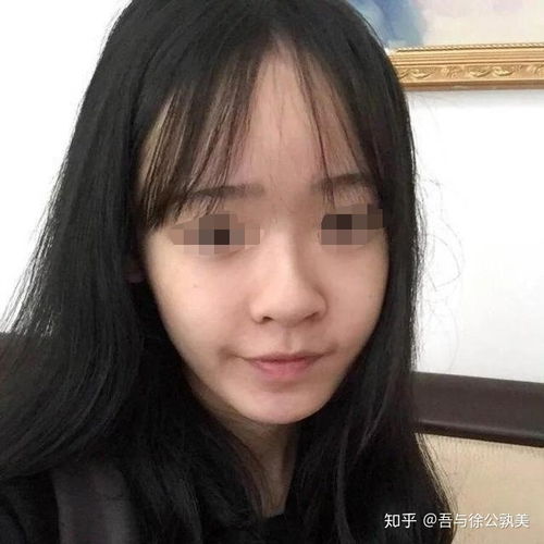 塌鼻子变挺是什么样的体验 