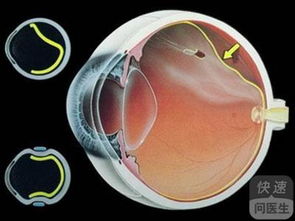眼球突出怎么治疗 是什么原因导致眼球突出
