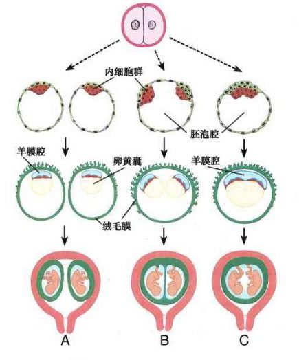 试管婴儿移植了1个胚胎却怀了双胎 这是什么情况