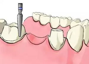 缺了牙,选择镶牙还是种植牙 