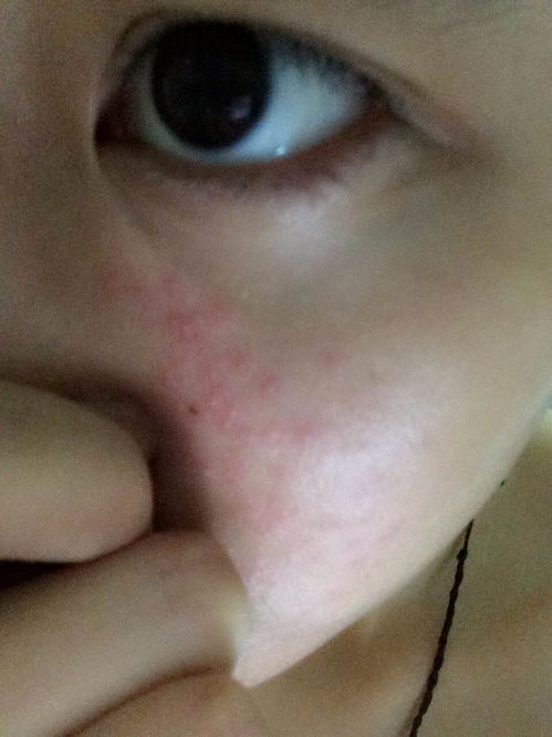 女朋友脸上起了红色的小痘,不疼不痒,请问是什么症状 什么原因 如何解决 