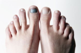 爱运动者切记,脚指甲如何影响你的健康