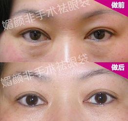 美容院整形眼袋视频（美容院整形眼袋视频教程） 美容院整形眼袋视频（美容院整形眼袋视频教程）《美容整形 眼袋》 整形美容