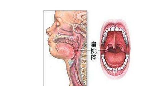 扁桃体什么情况下必须切除 