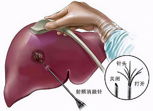 肝癌晚期的靶向药物治疗是什么(肝癌晚期靶向药物有哪些)