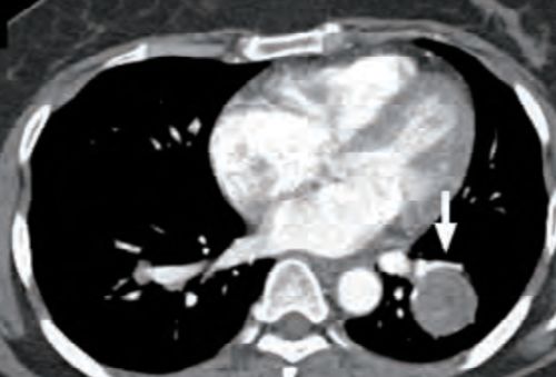 看完 8 种常见肺部占位影像特点,晋级肺部 CT 高手