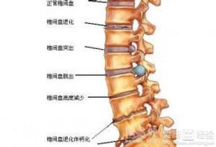 腰倍舒对治疗腰椎间盘突出真的有疗效吗