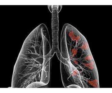 肺癌患者没力气怎么回事
