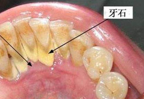 牙结石 可以自己抠掉吗 教你几招,帮助清除牙缝里脏东西