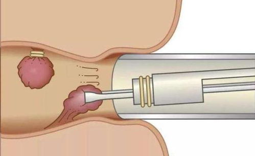肛门附近长出 小肉球 ,别只以为是痔疮,也可能是这2种疾病
