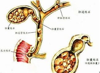 _四川结石病医院