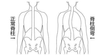 脊柱侧弯,不仅是形体之美的毒瘤,更是身体健康的杀手
