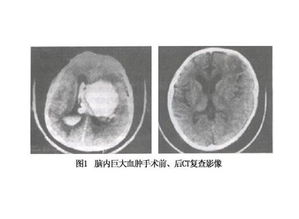 脑室出血 搜狗百科 