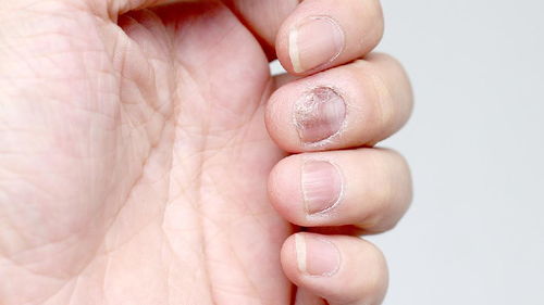 醋蒜治灰指甲效果如何 灰指甲概况 复禾健康 