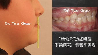 牙性和骨性地包天的区别