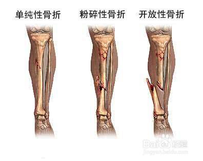 骨折该怎么做现场简单救护 