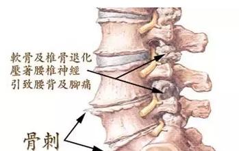 骨质增生是骨刺吗 怎么治疗