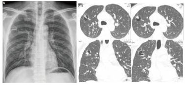 宣晟多学科会诊 两个病例认识肺大泡相关性肺癌 