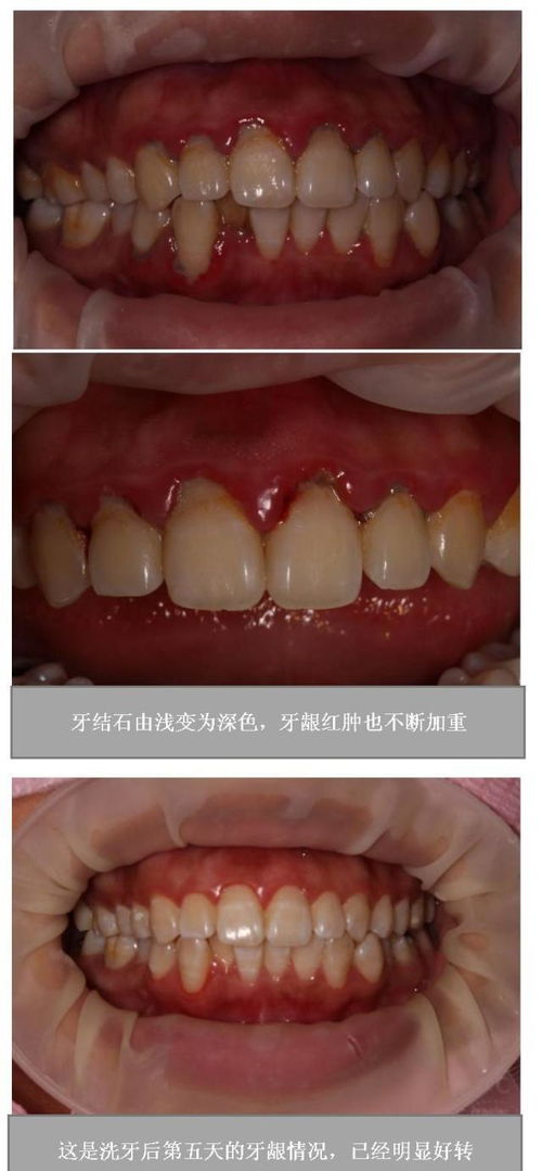 多少岁后不建议洗牙了