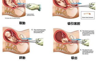 作为女人,你真的懂避孕吗