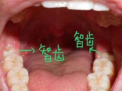 智齿长歪了需要拔吗(智齿长歪了需要拔吗必须拍片吗)